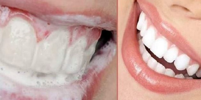 Как за несколько дней убрать зубные камни Подробнее читайте на Юж-Ньюз: http://xn----ktbex9eie.com.ua/archives/26711